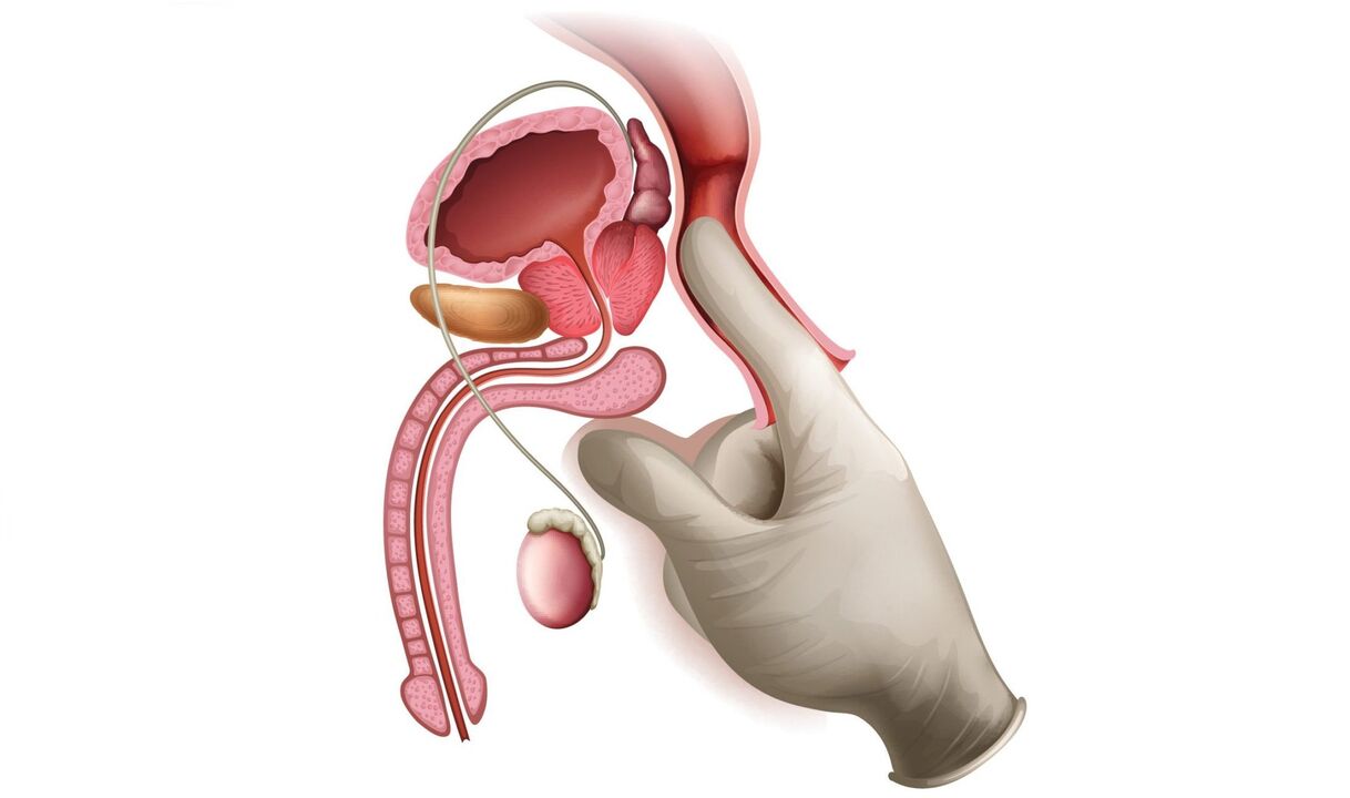 Prostate massage for prostatitis