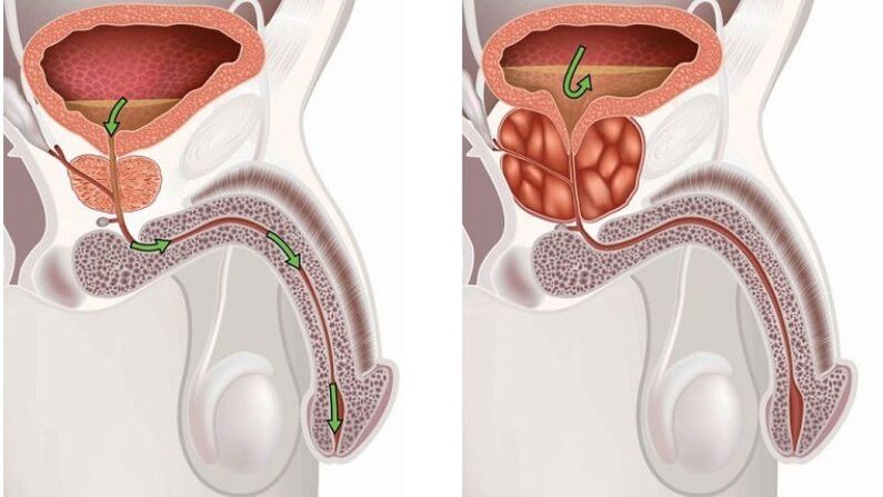 the prostate is healthy and becomes inflamed with prostatitis