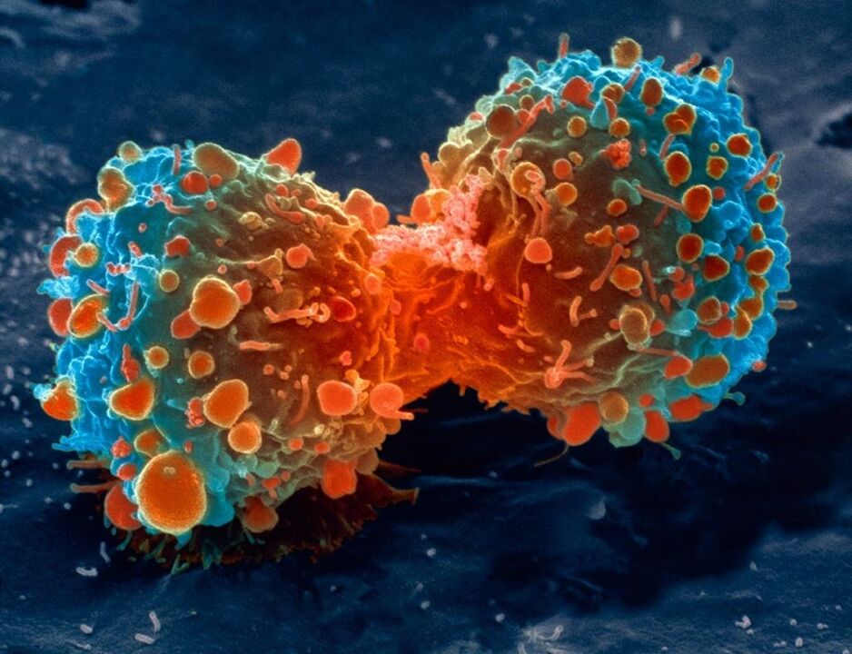 Tumor cells are a complication of prostatitis