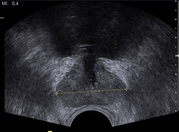 healthy prostate on ultrasound after using Predstonorm